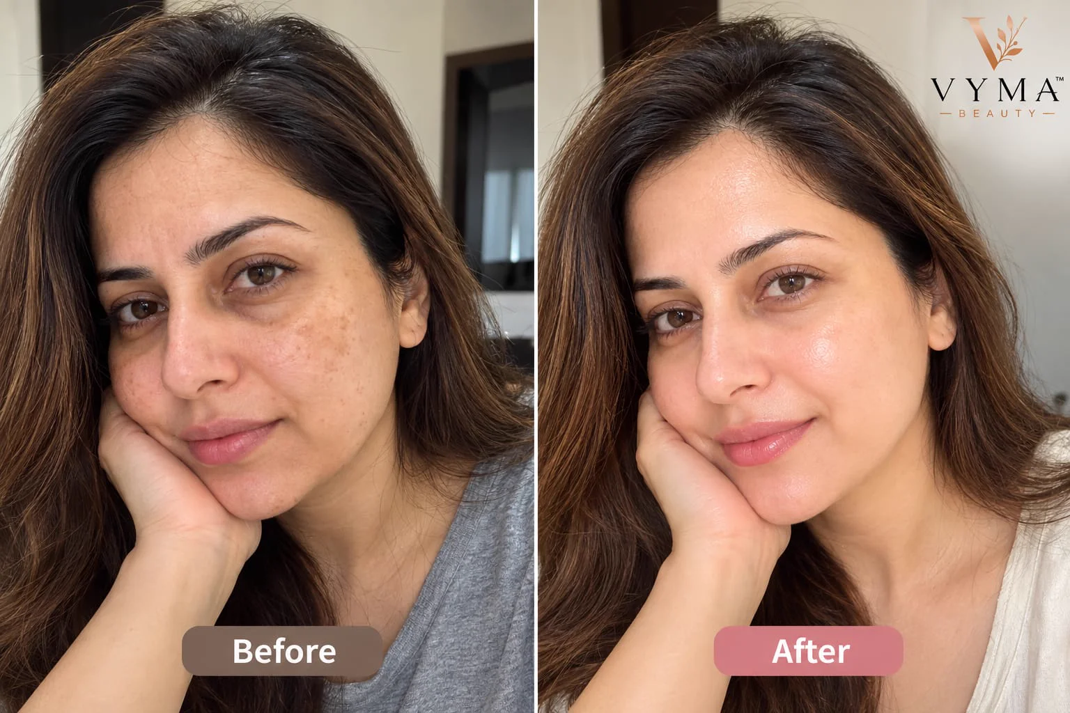 Full-Face Radiance & Melasma Fading - Priya S., 34 • Mumbai, India