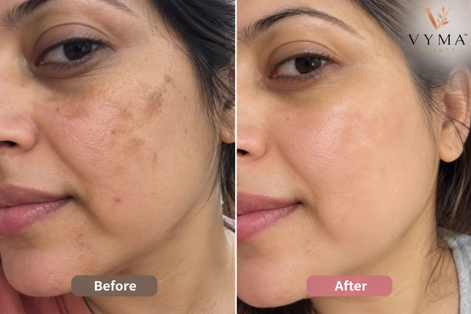 Cheek Pigmentation & Barrier Smoothing - Ananya M., 29 • Bengaluru, India